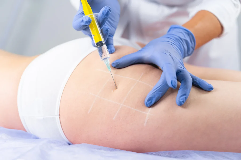 Hijamah Wet Cupping, Fat Dissolving & Aesthetics | Clinic 27:7 A person receiving a fat dissolving treatment, with a healthcare professional administering the injection in the hips.