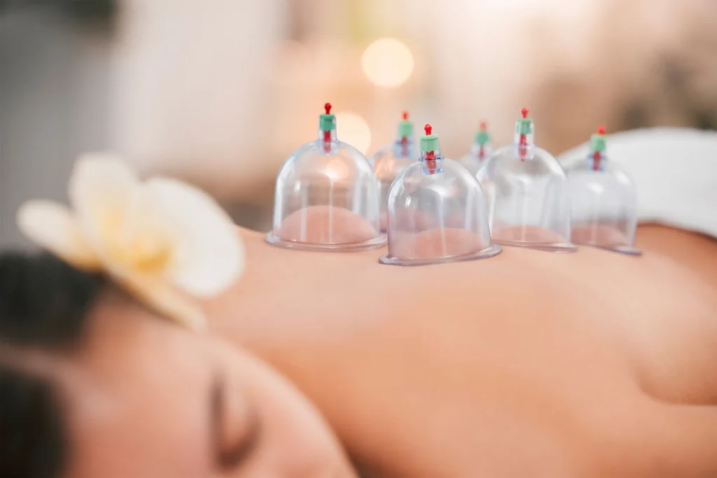 Hijamah Wet Cupping, Fat Dissolving & Aesthetics | Clinic 27:7 A woman receiving Hijamah Wet Cupping Therapy, with multiple cups placed on her back as part of the traditional cupping treatment.